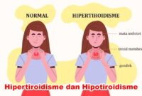 Hipertiroidisme dan Hipotiroidisme