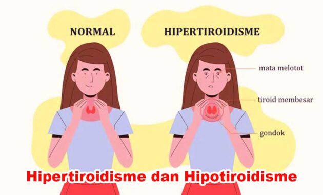 Hipertiroidisme dan Hipotiroidisme