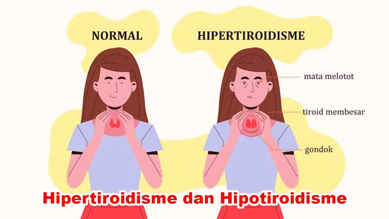 Hipertiroidisme dan Hipotiroidisme: Gangguan pada Sistem Endokrin