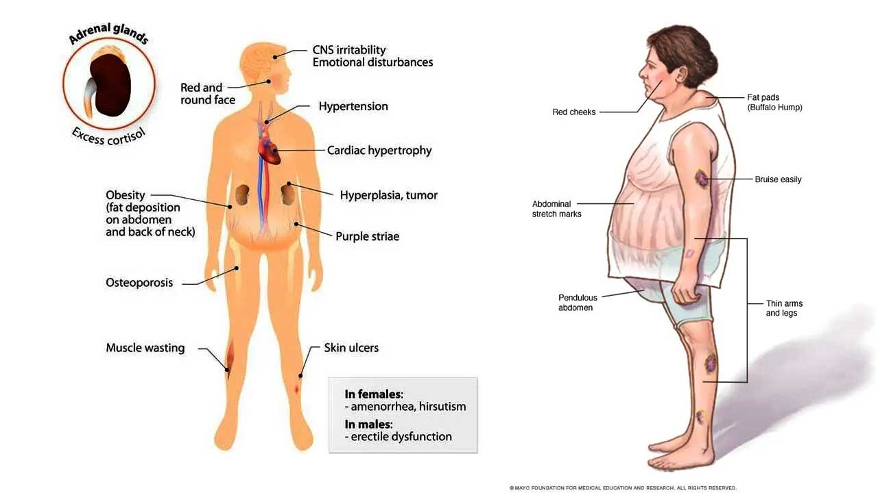 Sindrom Cushing: Penyebab, Gejala, Diagnosis, dan Pengobatan